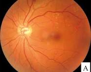 Sample image of Diabetic Retinopathy