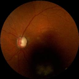 Sample image of Glaucoma